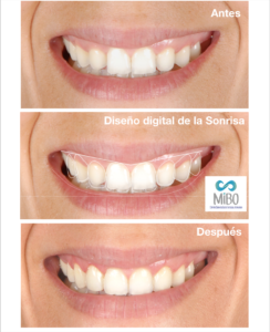 Diseño de la Sonrisa - MiBO Almeria (2)