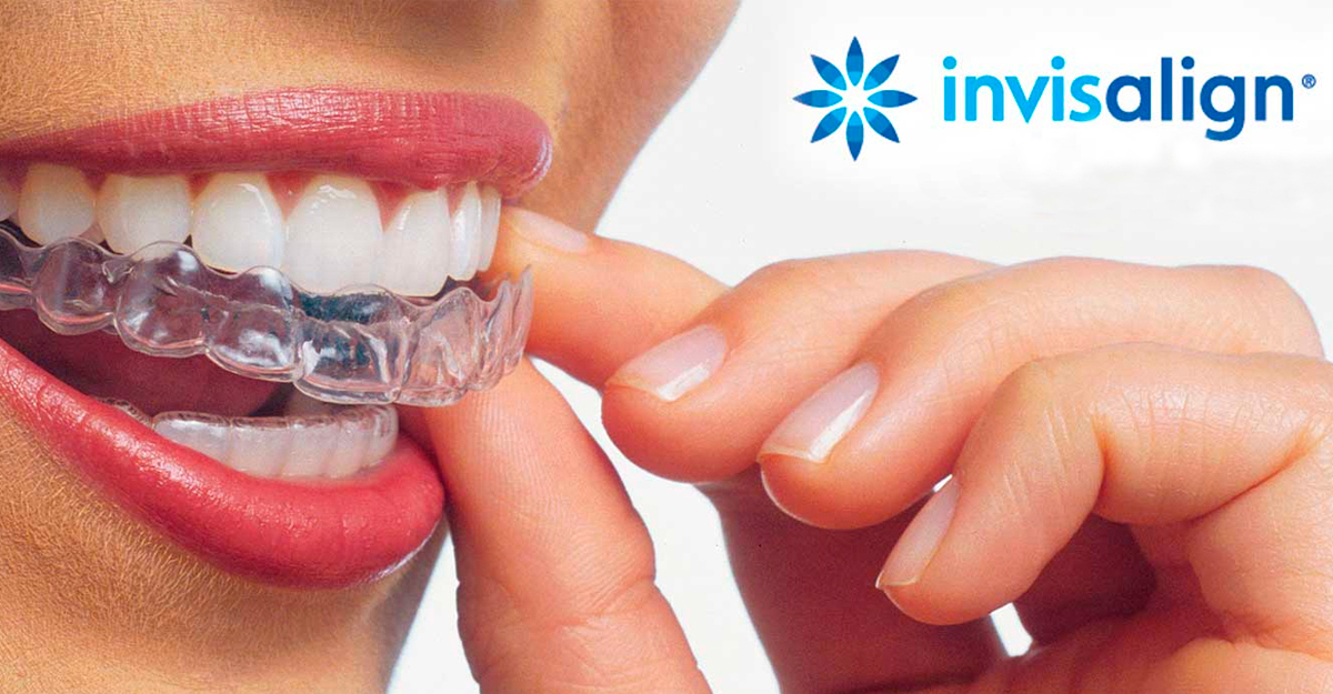 Invisalign-MiBO-Clinica-Dental- Almeria