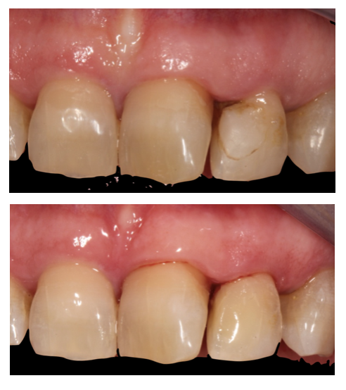 Obturación o Empaste Dental - MiBO Almeria