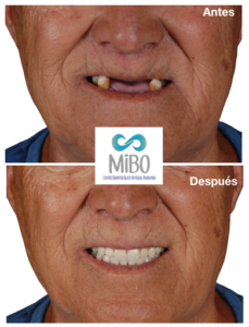 Protesis Removibles - MiBO Almeria