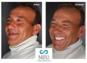 Protesis sobre Implantes - MiBO Almeria