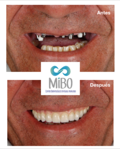 Protesis sobre Implantes - MiBO Almeria