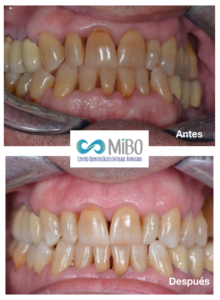 Blanqueamiento Dental Externo - MiBO Almeria