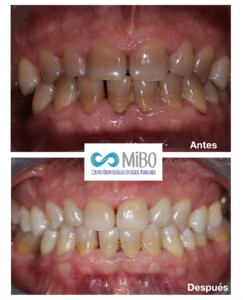 Blanqueamiento Dental Externo - MiBO Almeria