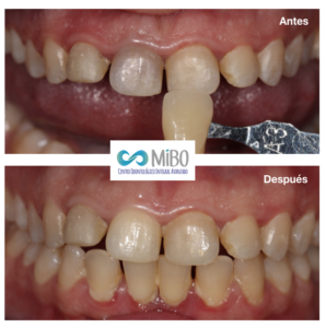 Blanqueamiento Dental Interno - MiBO Almeria