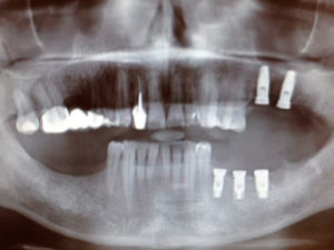 Implante-Dental---MiBO-Almeria