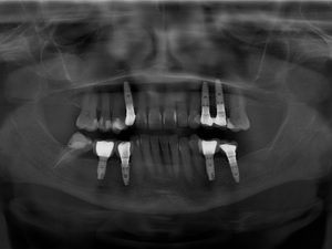 Implantes-Dentales-MiBO-Almeria