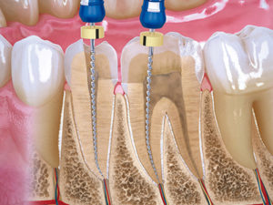 Endodoncia-o-Extraccion-MiBO-Clinica-Dental-Almeria
