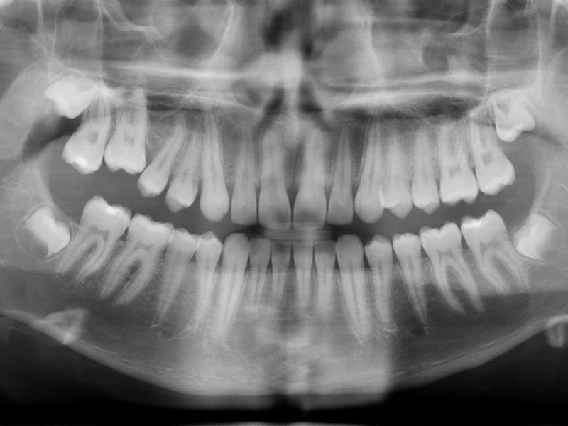 Radiografia-Panoramica---MiBO-Clinica-Dental-Almeria