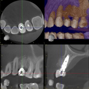implantes dentales almeria