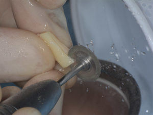 Injerto-Oseo-Dental---MiBO-Almeria-2