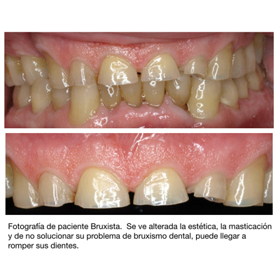 Férula de Descarga Dental y Bruxismo - MIBO ALMERÍA