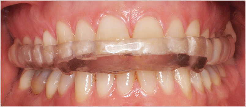 Férulas de Descarga para Bruxismo en Cardedeu - Clínica Dental