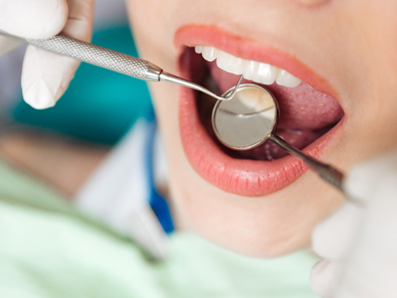 Empastes-Dentales-Clinica-Dental-MiBO