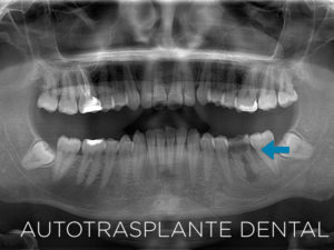 Autotrasplante-Dental---MiBO-Almeria