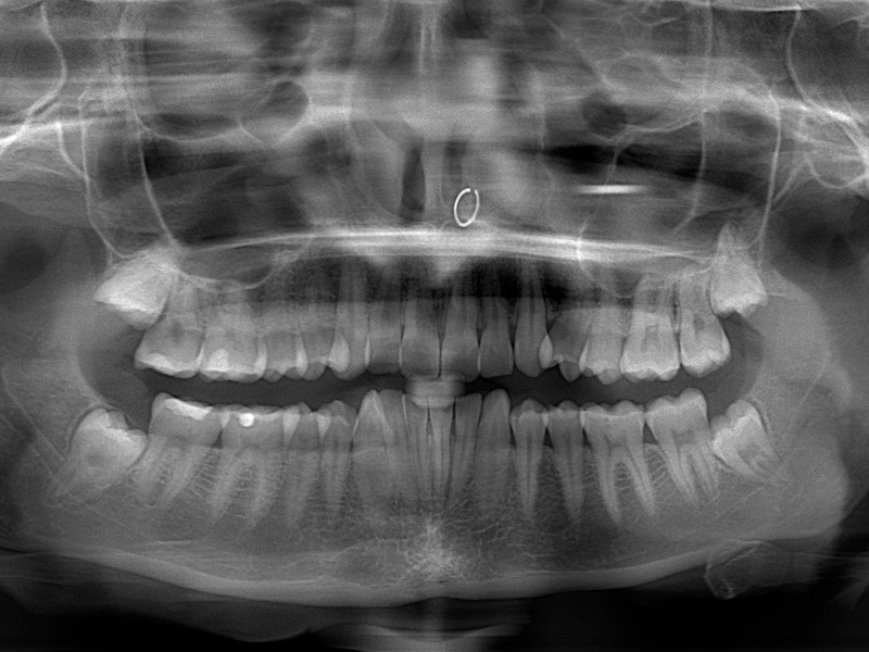 ¿Cuánta radiación recibo en una radiografía dental? ¿Es peligrosa?