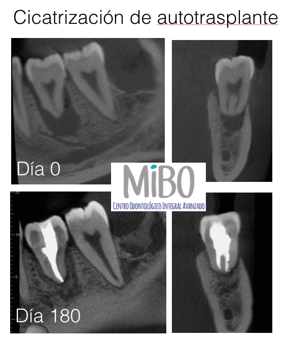 curacion_autotrasplante_dental_mibo_dentista_clinica_almeria
