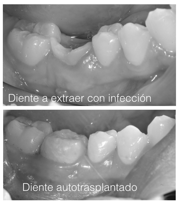 extraccion_dental_autotrasplante_clinica_dental_mibo_almeria