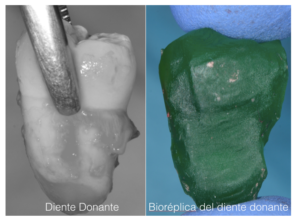 implante_dental_natural_autotrasplante_clinica_mibo_almeria