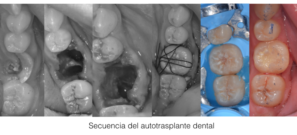 secuencia_autotrasplante_dental_clinica_mibo_almeria_dentista