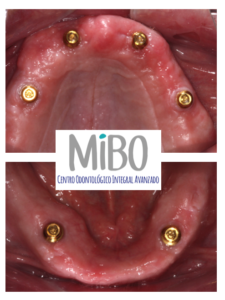 sobredentadura_dental_implantes_clinica_mibo_almeria_locator