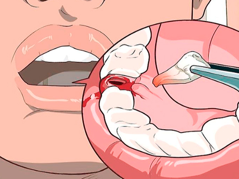 Alveolitis tras extracción dental: ¿Qué es, síntomas,  tipos y cómo se trata?