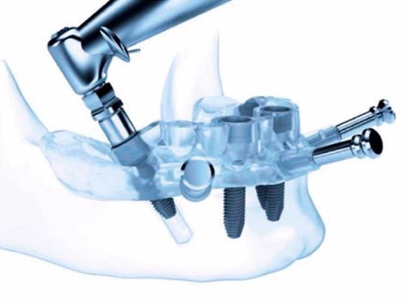 Cirugía guiada por ordenador en Implantes Dentales