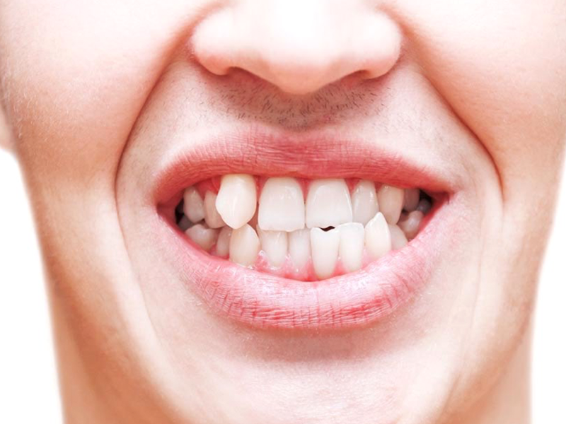 Razones para corregir tus dientes torcidos y apiñados