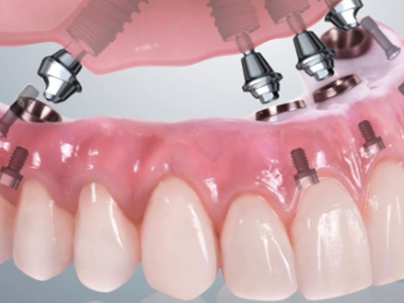 Prótesis híbrida sobre implantes dentales: ¿son todas iguales?¿Cuándo está indicada? ¿Qué material es el mejor? Cuidados y mantenimiento.