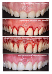 alargamiento_coronario_clinica_dental_mibo_almeria_dentista_estetica_cirugía_carillas