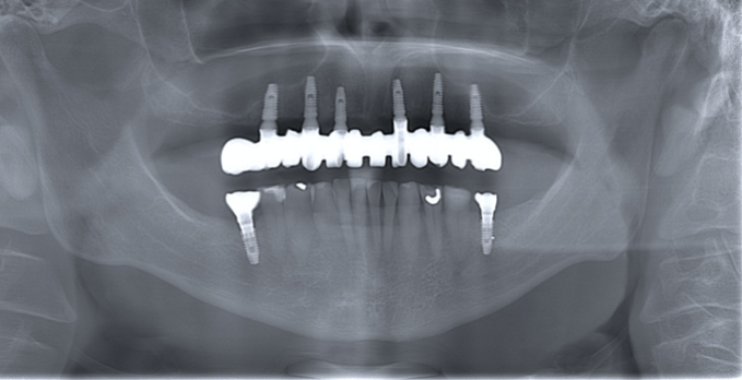 implantes dentales almeria