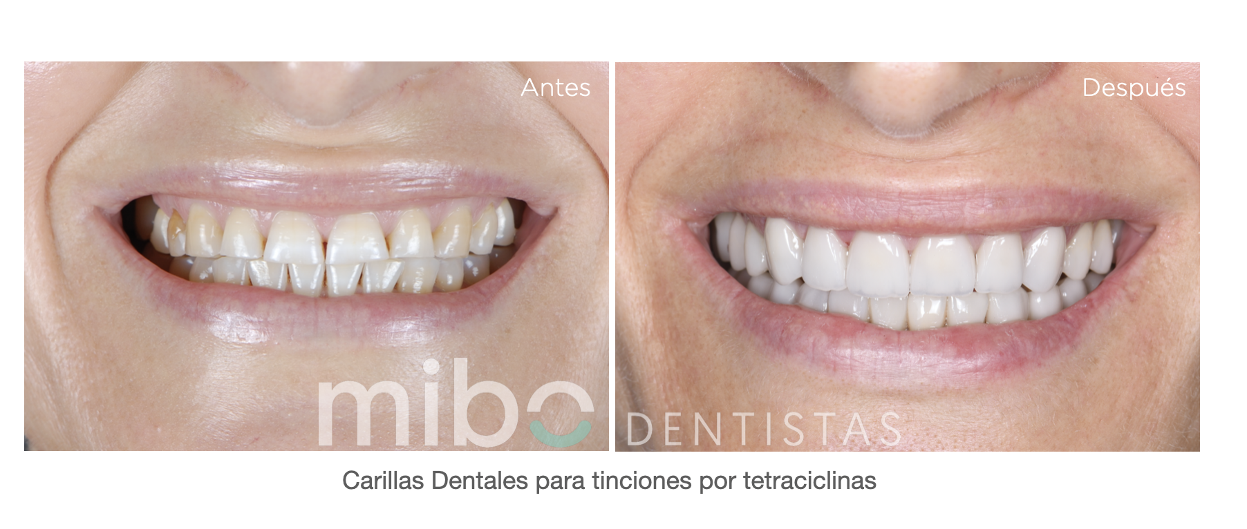 tetraciclinas carillas dentales estetica dental mibo almeria