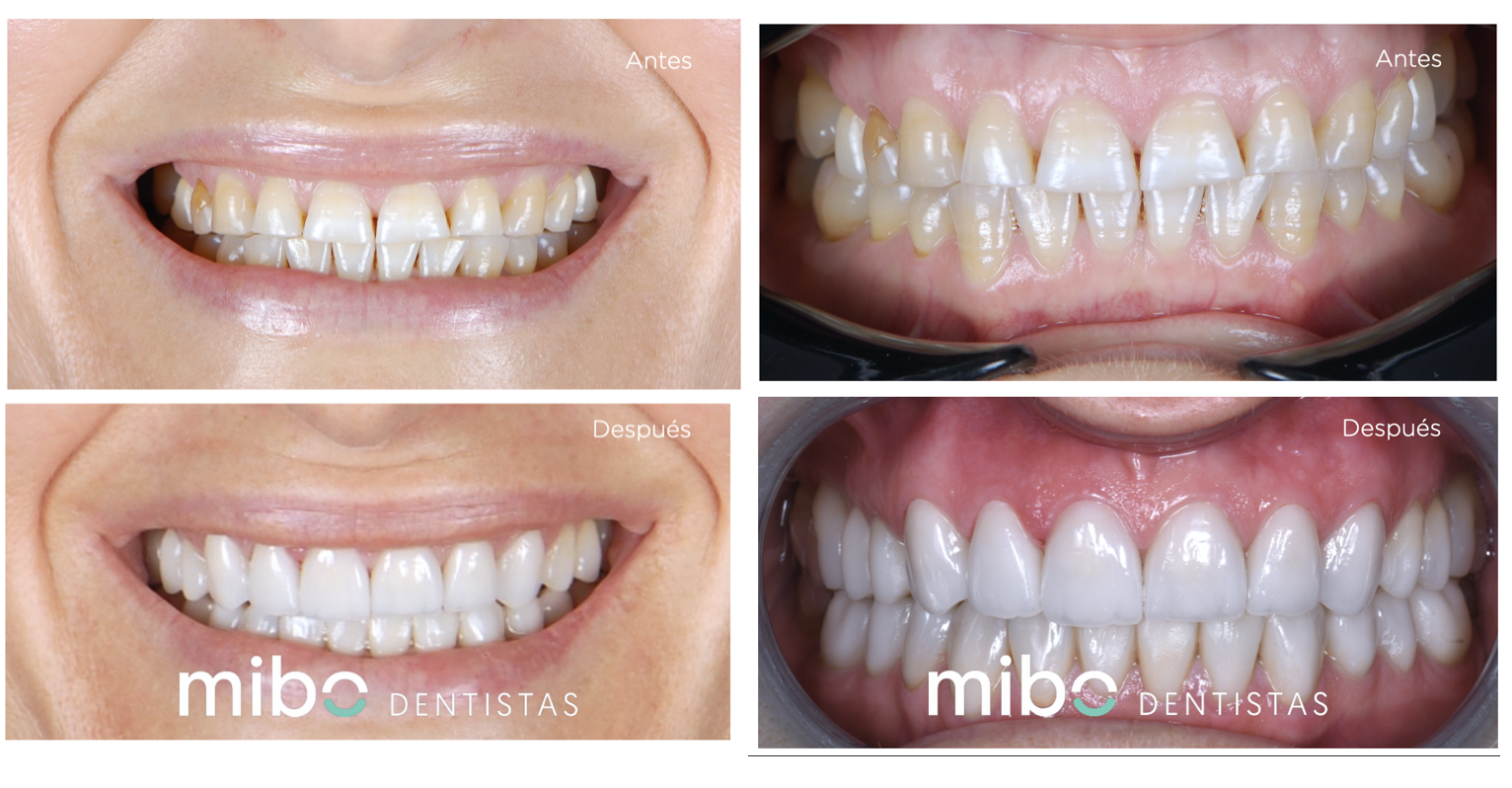 Diferencias entre las coronas de zirconio y de 100% porcelana – Estudi  Dental Barcelona