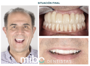 resultado final del paciente con tratamiento de implantes dentales de boca completa