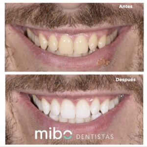 blanqueamiento_dental_almeria_dentista