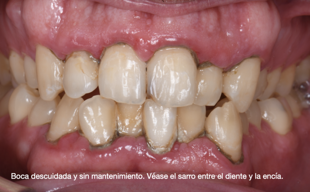 boca_sarro_almeria_dentista_curetaje_mibo_dentistas
