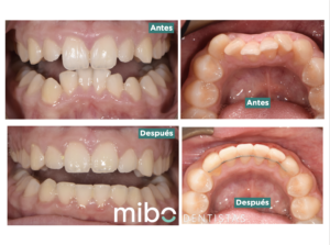 ortodoncia adultos almeria dentista